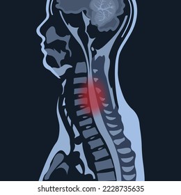 magnetic resonance image or MRI of the cervical spine in sagittal projection demonstrating cervical spondylosis and spinal cord compression. The disease causes neck pain and radiculopathy.