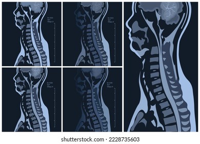 Magnetic resonance imaging of the cervical spine spine. Spondylosis and spinal cord compression. 