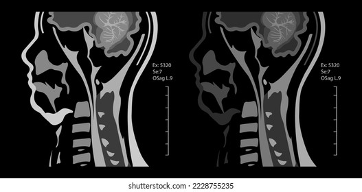 Magnetic resonance imaging of the cervical spine spine. Spondylosis and spinal cord compression.