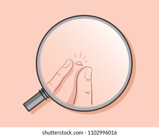 Magnifier finding acne on skin. Skin healthcare illustration