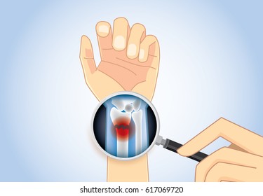 Magnifier On Hand Magnifying Inner Arm For Looking Wrist Fracture. Illustration About Medical Concept.