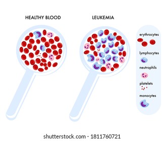 Magnifying Glass With Normal Blood And With Leukemia.Medical Science Education And Healthcare Awareness.Cells Erythrocytes, Leukocytes,neutrophils.Blood Cancer Or Hemophilia Concept.Diagnosis Diagram