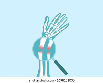 Magnifying glass zooms in broken arm bone vertor illustration in x-ray style for Emergency accident injury concept.