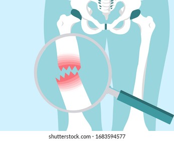 Magnifying glass zooms in on Thigh broken.  Bone vector illustration in x-ray style for. Emergency accident concept.