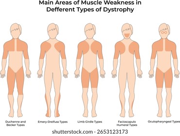 Principais áreas de fraqueza muscular em diferentes tipos de distrofia
