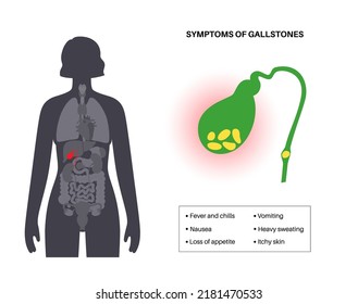 Main Gallstones Symptoms. Nausea, Vomiting, Loss Of Appetite, Fever And Diarrhea. Gallbladder Stones Disease Treatment. Digestive System Problems. Biliary Duct Anatomy Medical Vector Illustration.