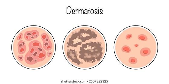 Hauptsorten der Dermatose. Dermatose, Duncan's schmutzige Dermatose und Grover's vorübergehende akantholytische Dermatose. Menschliche Hautkrankheiten. Farbvektorgrafik.