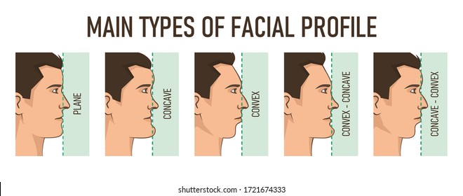 Main types of facial profile - convex, concave, plane.