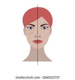 Malar pad, suf removal. Comparison of female face before and after plastic surgery. Vector illustration