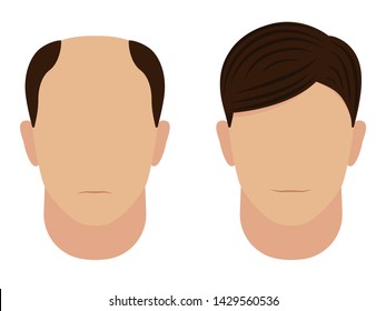 Calvicie masculina antes y después. Concepto de trasplante capilar. Hombre con la cabeza calva y una hermosa peluca. Ilustración vectorial aislada en blanco.