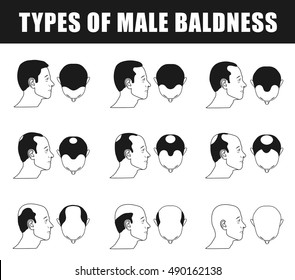 Male Pattern Baldness Images Stock Photos Vectors Shutterstock