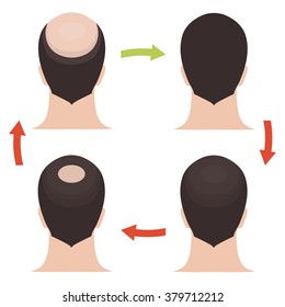 Male baldness pattern stages set. Rear view of a man with alopecia before and after hair treatment and transplantation. Vector illustration.