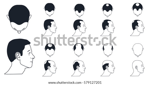 男性のはげの種類 ノーウッドスケール 禿げ上がり のベクター画像素材 ロイヤリティフリー
