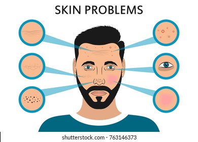 Male face skin problems. Acne and pimples, black spots, redness, dryness, circles under the eyes and wrinkles. Vector illustration for cosmetic brochure or banner, poster.