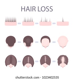 Male and female pattern hair loss set. Stages of baldness in men and women. Number of follicles on scalp in each step. Alopecia infographic medical vector template for clinics and diagnostics centres.