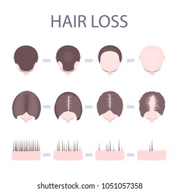 Male and female pattern hair loss set. Stages of baldness in men and women. Number of follicles on scalp in each step. Alopecia infographic medical vector template for clinics and diagnostics centres.