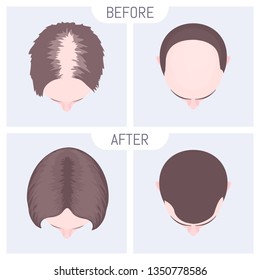 Male and female pattern hair loss set. Baldness treatment result in men and women. Before and after concept. Alopecia infographic medical vector template for clinics and diagnostics centres.