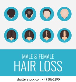 Male and female pattern hair loss set. Stages of baldness in men and women. Alopecia infographic medical design template.  Vector illustration.