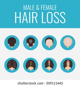 Male And Female Pattern Hair Loss Set. Stages Of Baldness In Men And Women. Alopecia Infographic Medical Design Template.  Vector Illustration.