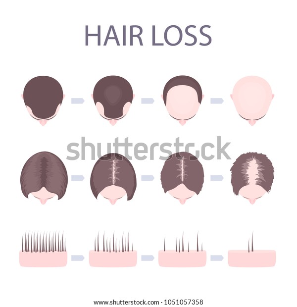 Male Female Pattern Hair Loss Set Stock Vector (Royalty Free) 1051057358