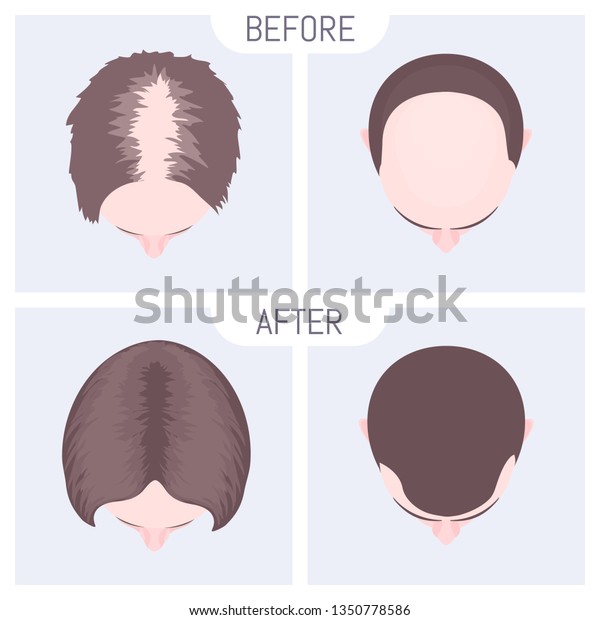 Male Female Pattern Hair Loss Set Stock Image Download Now