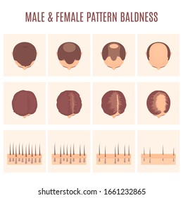 Male and female-pattern hair loss set. Stages of baldness in men and women. Head in top view. Number of follicles on scalp in each step. Alopecia infographic medical vector illustration.