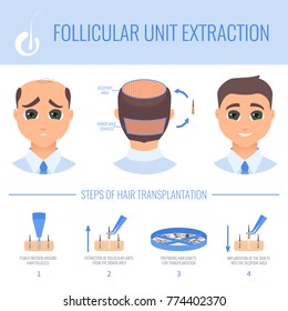 Male hair loss FUE medical treatment. Stages of follicular unit extraction procedure. Alopecia infographic design template for transplantation clinics and diagnostic centers. Vector illustration.