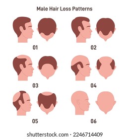 Male hair loss pattern set. Hair loss, balding process. Male alopecia. Flat vector illustration