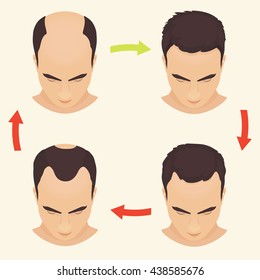 Male hair loss stages set. Man before and after hair treatment and transplantation. Male pattern baldness. Vector illustration.
