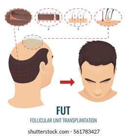 Male hair loss treatment with follicular unit transplantation. Stages of FUT procedure. Alopecia infographic medical design template. Clinics and diagnostic centers concept design. Vector illustration