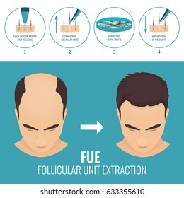 Male Hair Loss Treatment With Follicular Unit Extraction. Stages Of FUE Procedure. Alopecia Infographic Medical Design Template For Transplantation Clinics And Diagnostic Centers. Vector Illustration.