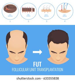 Male hair loss treatment with follicular unit transplantation. Strip method. Stages of FUT procedure. Alopecia infographic medical template. Clinics and diagnostic centers design. Vector illustration.