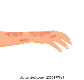 Male hand with serious burn injury