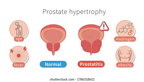 Mit jelent a prostatitis
