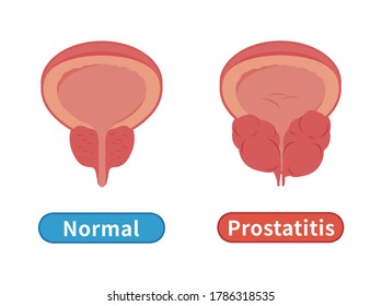 Male Healthy And Unhealthy Prostate, Prostate Hypertrophy And Inflammation Isolated On White Background