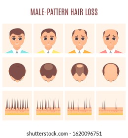 Male pattern hair loss set. Stages of baldness in men. Treatment result in front and top view. Number of follicles on scalp in each step. Alopecia infographic medical vector illustration.