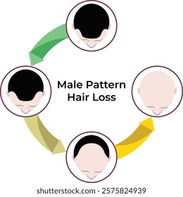 Male Pattern Hair Loss Stages Design Vector Illustration