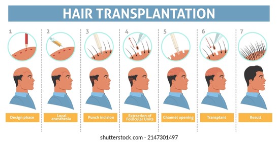 Male person hair transplantation step vector poster. Bald man treatment with implant illustration. Alopecia disease cure infographic. Mesotherapy and follicular unit extraction procedure