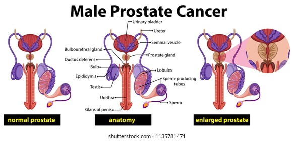 5,693 Prostate anatomy Images, Stock Photos & Vectors | Shutterstock