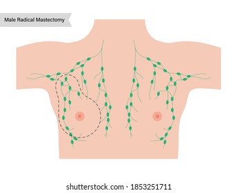 Male Radical Mastectomy Concept. Patient Consultation Before Operation. Lymph Nodes In The Human Breast In Man Body. Medical Poster With Chest And Nipple Anatomy. Isolated Flat Vector Illustration.