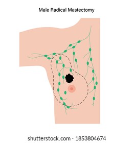 Male Radical Mastectomy Concept. Surgery To Remove A Cancerous Tumor. Cancer In Man Body. Patient Consultation Before Operation. Chest And Nipple Anatomy. Medical Isolated Flat Vector Illustration.