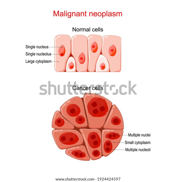 悪性腫瘍 がんと正常細胞 健康な組織と腫瘍の比較と違い 染色質 核 細胞質の詳細 のベクター画像素材 ロイヤリティフリー 1924424597