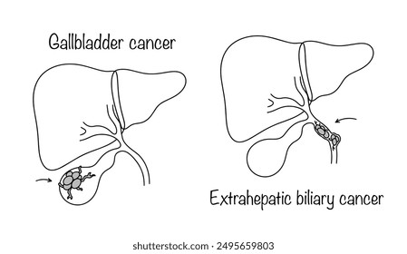 A malignant neoplasm that affects the gallbladder, as well as part of the bile ducts that are located outside the liver. Medical vector illustration on cancer theme. Vector illustration.