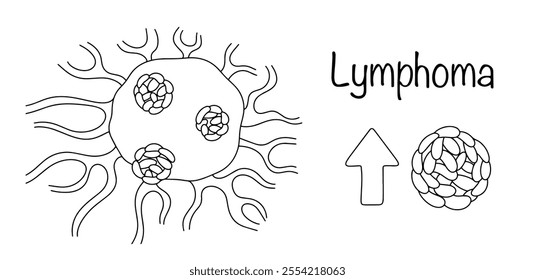 A malignant tumor formed by the main cells of the immune system - lymphocytes. Drawn tumor and increased number of lymphocytes. Line drawn medical vector.