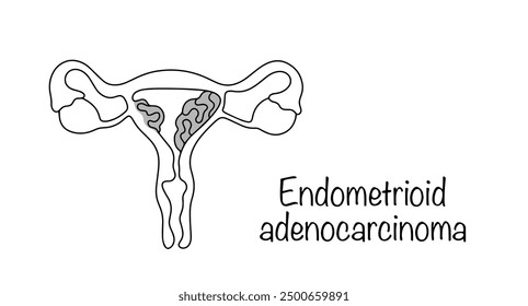 A malignant tumor of the uterine body that develops from glandular epithelial cells. Women's disease. Gynecology vector illustration.