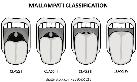 Mallampati Classification - Oral Airway Assessment	
