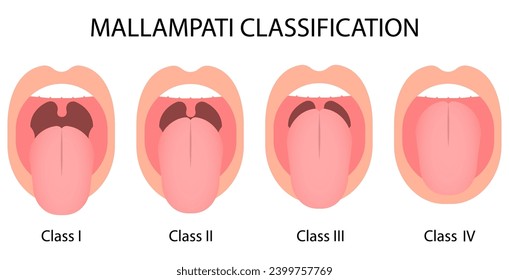 Mallampati Classification score. Oral airway intubation. Medical procedure vector illustration isolated on white background