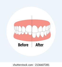 Malocclusion Overbite. Dental problem vector illustration. Dental care concept.