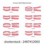 Malocclusion. Tooth open bite protruding mouth jaw problem orthodontics infographic, overbite underbite human teeth anatomy dental structure, dentistry swanky vector illustration