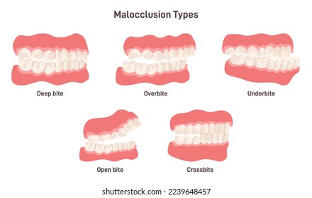 Malocclusion types set. Human crooked teeth. Misalignment or incorrect relation between the teeth of upper and lower jaw. Flat vector illustration